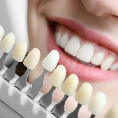 Tooth Color Matching