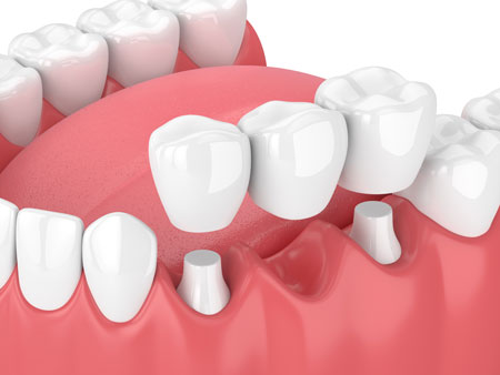 Dental Bridge Dental Bridge