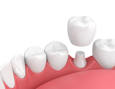 Dental Crown Placement