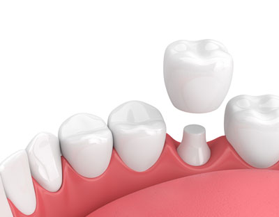 Dental Crown Placement Dental Crown Placement