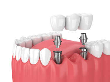 Dental Implant Bridge