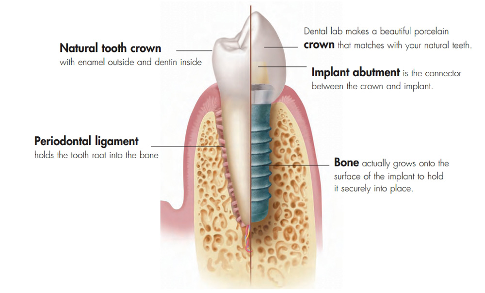 Dental Implants Illustration and Explanation