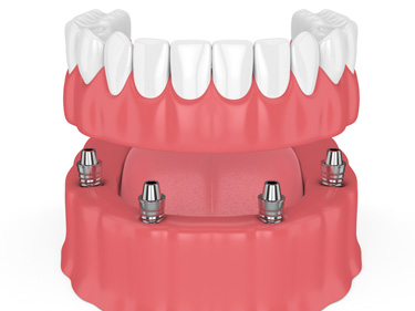 Full Mouth Dental Implants