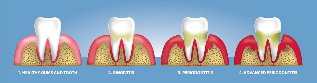 Periodontal Disease Stages