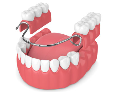 Removable Partial Dentures