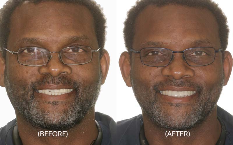 Front Teeth Porcelain Crowns Before & After