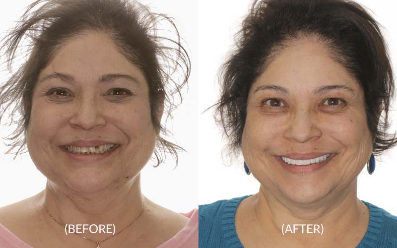Full Smile Makeover Before & After